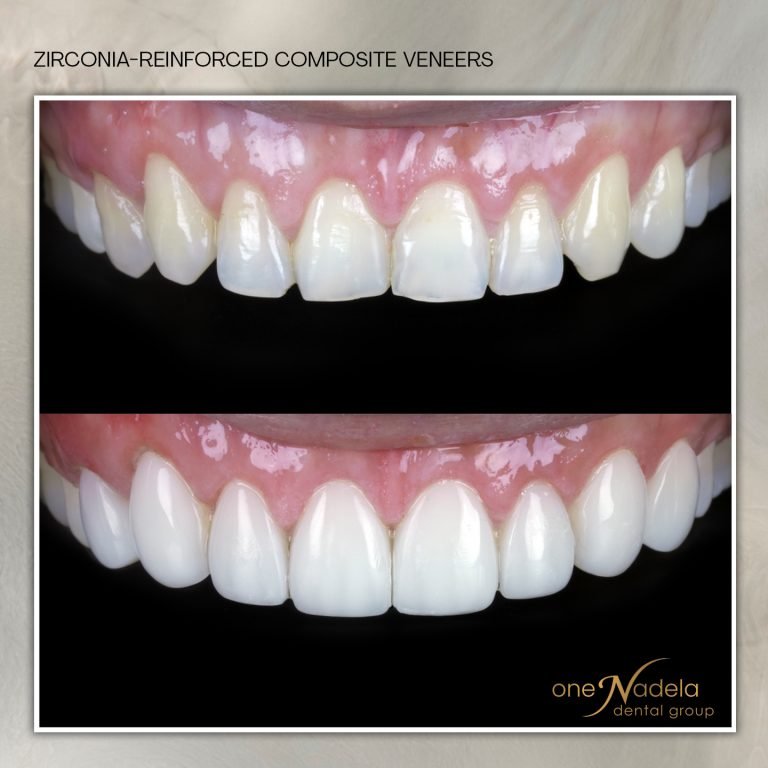 Before and after zirconia-reinforced composite veneers by One Nadela Dental Group