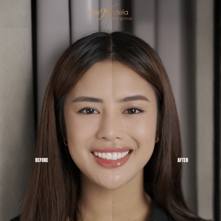 Emax Porcelain Veneers: The Gold Standard for a Natural and Confident Smile